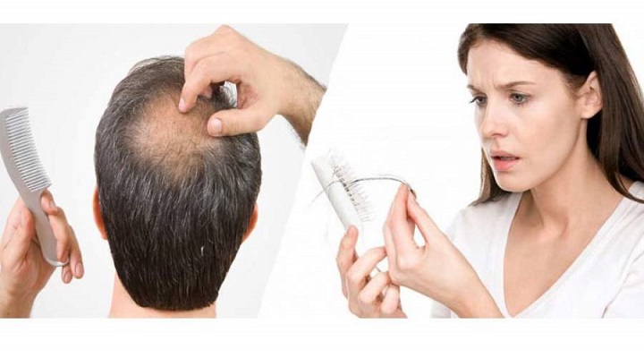 اشتباهات رایج در کاشت مو چیست